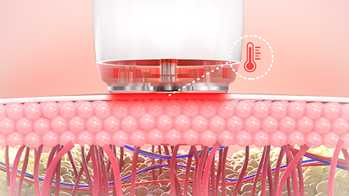 Sensor de temperatura en handpiece de Radiofrecuencia Facial Apollo Duet